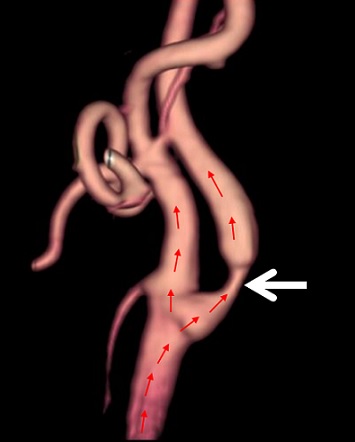 The carotid arteries..